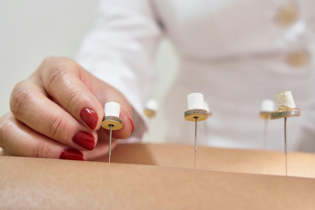 Traditional Acupuncture
